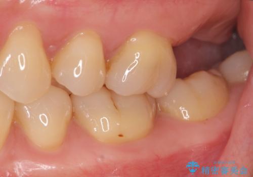 噛むと歯が疼く 歯牙破折からのインプラント治療の治療前