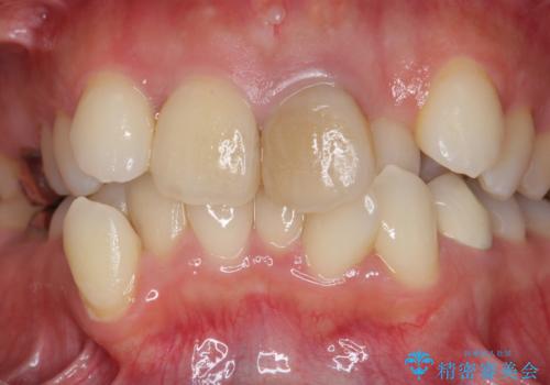 著しいがたつきによる清掃困難 歯牙抜去とセラミック治療の治療前