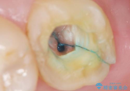 噛むと歯が疼く 歯牙破折からのインプラント治療