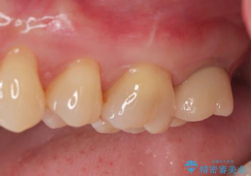 噛むと歯が疼く 歯牙破折からのインプラント治療の症例 治療後