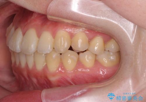 前歯のねじれ 矯正治療による歯並び改善の治療中