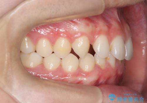 【ワイヤー矯正】歯列の隙間を閉じたいの治療前