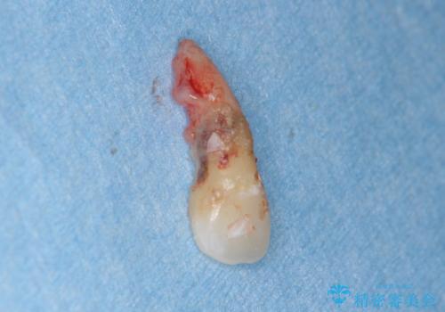 著しいがたつきによる清掃困難 歯牙抜去とセラミック治療の治療前