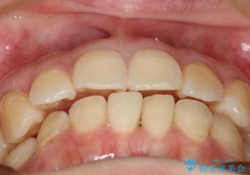 下の前歯のガタつきを治したい インビザライン・ライトパッケージの治療前