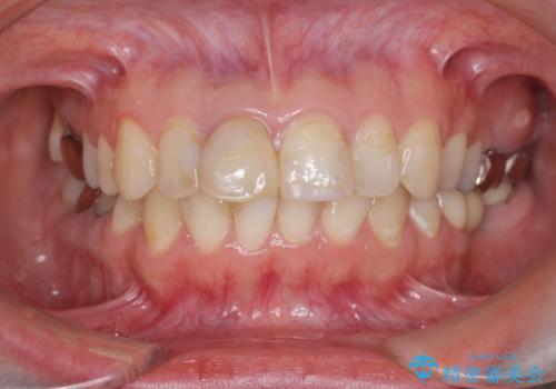 虫歯だらけの前歯をセラミック治療の症例 治療前