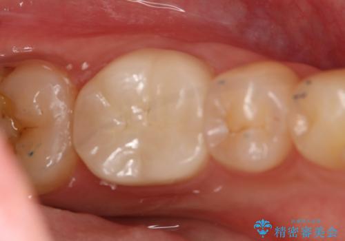 左下奥歯が腫れて痛い フルジルコニアクラウンの治療後
