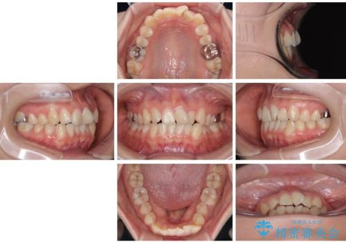 前歯のねじれ・ガタガタを10か月で改善!20代女性の矯正治療|クリアブラケットでむし歯になりにくい歯並びへ改善の治療前