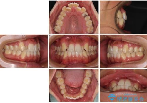 八重歯と前歯のガタガタを抜歯矯正で治療|クリアブラケット使用例の治療前