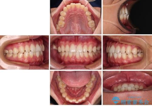 前歯のガタガタ・奥歯のかみ合わせ(シザーズバイト)を改善|1年半で完了したメタルブラケット矯正の治療前