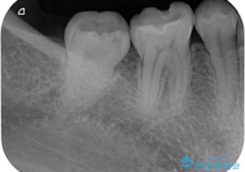 右下に虫歯ができた セラミックインレー修復の治療前