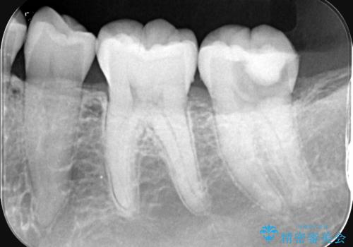 奥歯の激しい痛みを解消し、歯を長持ちさせる精密治療の治療前