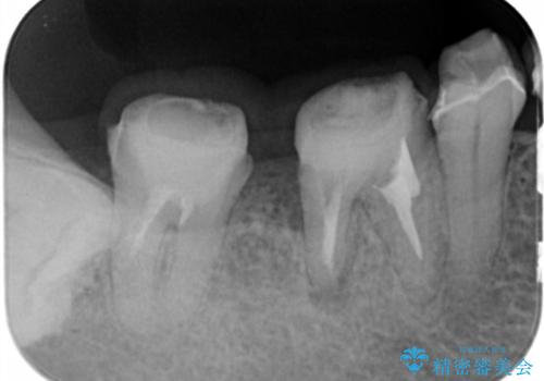 [ 奥歯の歯周病 ] エムドゲインを用いた再生治療の治療中