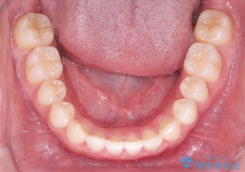 【ワイヤー矯正】歯列の隙間を閉じたいの治療後