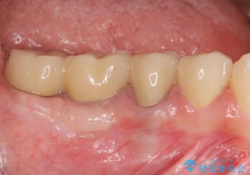 遊離歯肉移植術を伴うインプラント治療の症例 治療後