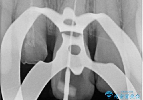 前歯の色が気になる!|他院で抜歯と言われた|歯を残したい|精密根管治療とオールセラミッククラウンで治療の治療中