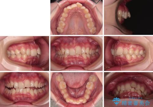 【モニター】デコボコと隠れてしまう前歯 ワイヤー装置による抜歯矯正で美しい口元にの治療前