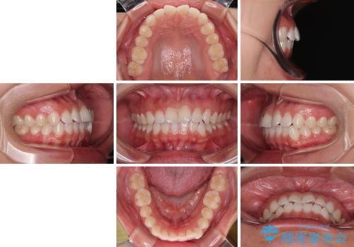 【モニター】マウスピース矯正が煩わしい ワイヤー装置での非抜歯矯正の治療前