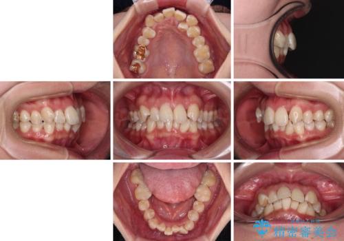 【モニター】前歯のデコボコをワイヤーの抜歯矯正で綺麗に整えるの治療前
