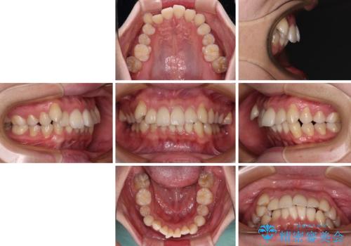 【モニター】八重歯とデコボコを治したい 補助装置を併用したワイヤー矯正の治療前