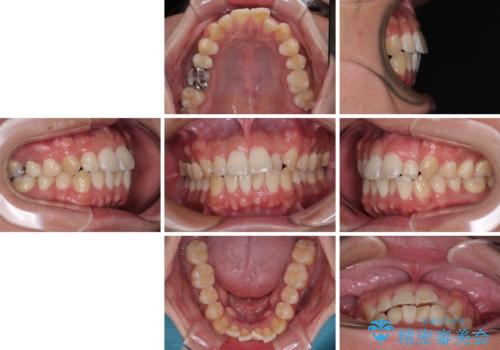 前歯のデコボコをささっと治す 短期間でのインビザライン矯正治療の治療前