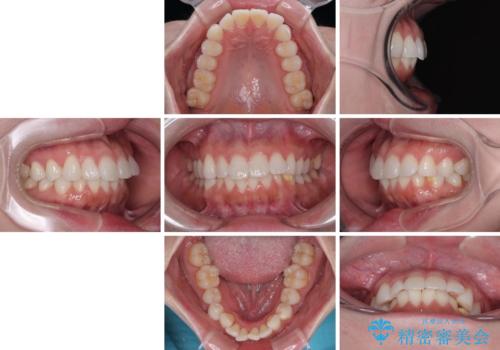 気になる前歯を短期間で治す インビザライン・モデレートでの矯正治療の治療前