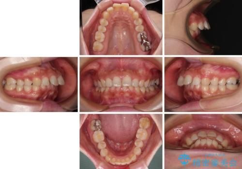 出っ歯を治したい ワイヤー装置での抜歯矯正の治療前