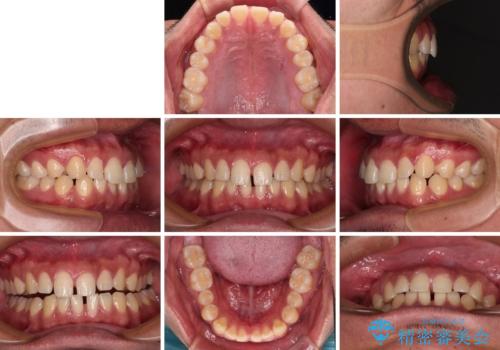 隙間だらけの歯列を治したい ワイヤー矯正での矯正治療の治療前