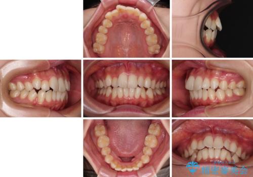 横顔の印象を改善したい ワイヤー装置での抜歯矯正の治療前