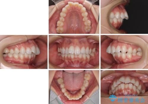 膨らんだ口元を改善する抜歯矯正 インプラント治療も同時に行う総合歯科治療の治療前