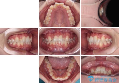 前歯のクロスバイト 裏側に隠れた歯をワイヤー装置で短期間治療の治療前