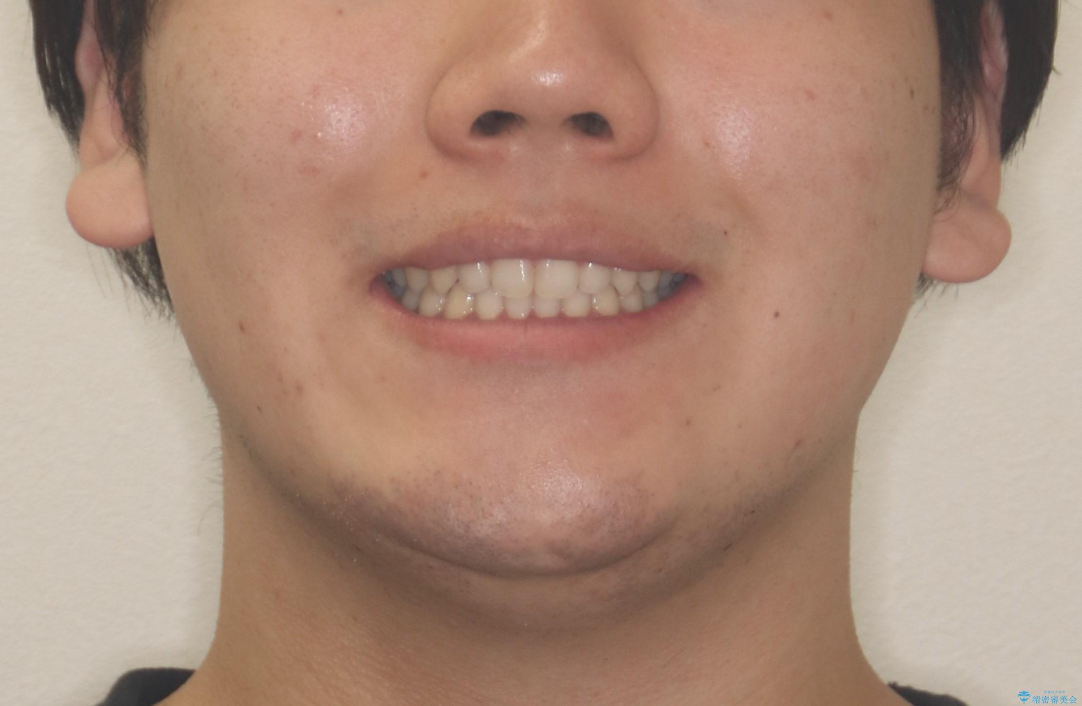 【ワイヤー矯正】歯列の隙間を閉じたいの治療後(顔貌)