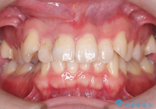 【セラミッククラウン】【精密根管治療】前歯が痛いの症例 治療前