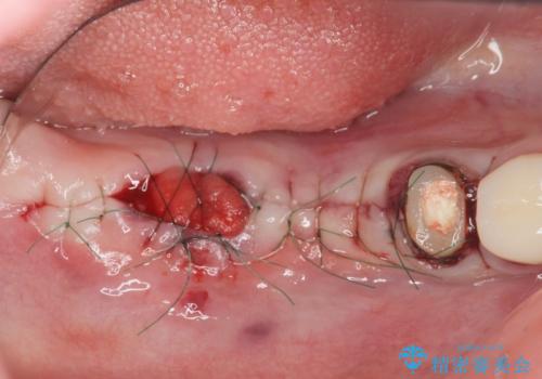 遊離歯肉移植術を伴うインプラント治療の治療前