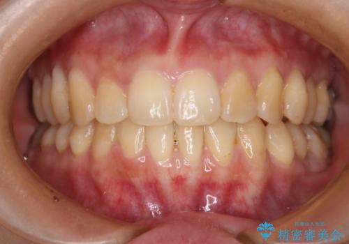 下の前歯のガタつきを治したい インビザライン・ライトパッケージ