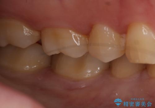 奥歯の虫歯を治療したい セラミックインレーの治療後