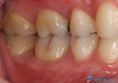 奥歯の再治療をしたい　ゴールドインレーの治療前