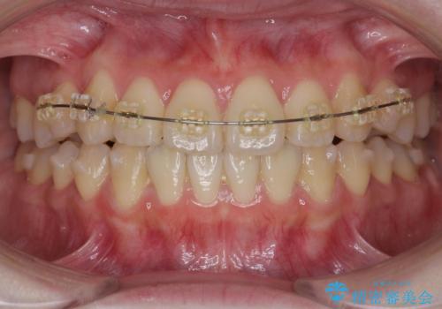 前歯のねじれ 矯正治療による歯並び改善の治療中