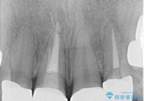 虫歯だらけの前歯をセラミック治療の治療後