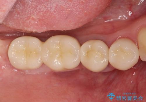 遊離歯肉移植術を伴うインプラント治療の治療後