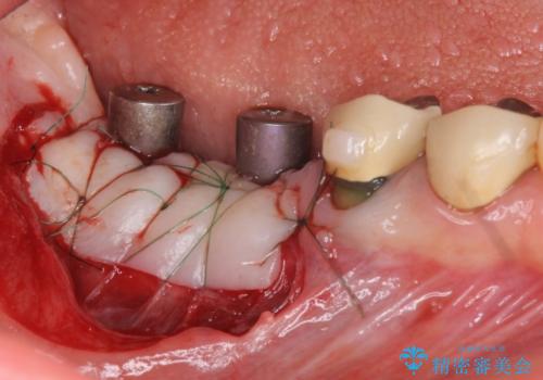 遊離歯肉移植術を伴うインプラント治療の治療中