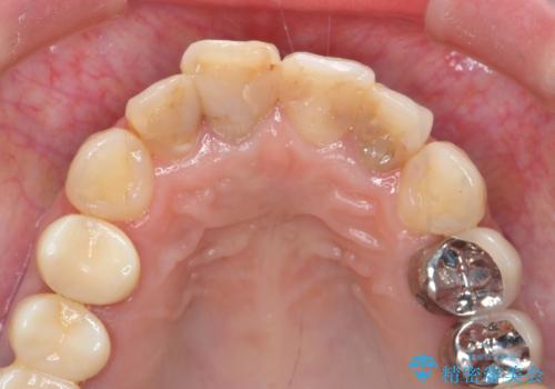 虫歯だらけの前歯をセラミック治療の治療前