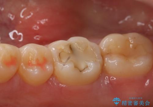 奥歯の虫歯を治療したい　セラミックインレーの治療前