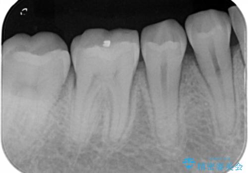 奥歯の虫歯を治療したい セラミックインレーの治療前