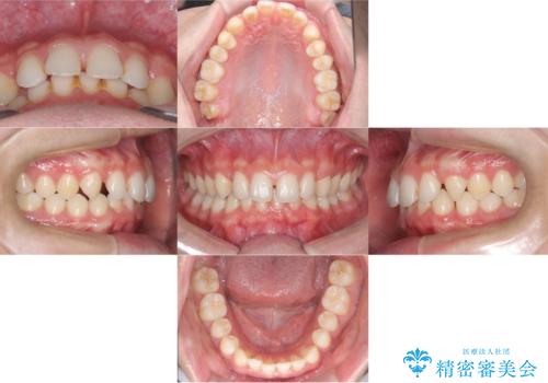 【ワイヤー矯正】歯列の隙間を閉じたいの症例 治療前