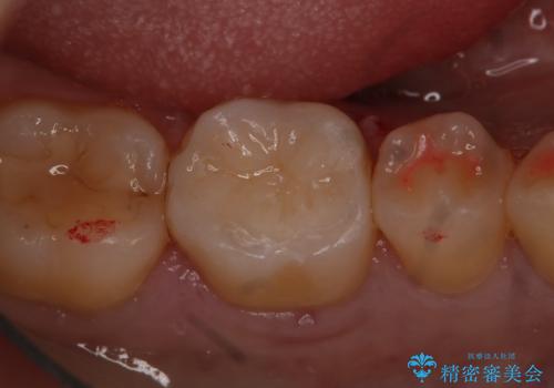 奥歯の虫歯を治療したい　セラミックインレーの症例 治療後