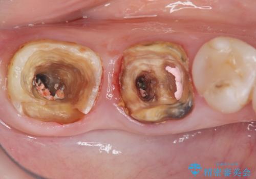 [ 奥歯の歯周病 ] エムドゲインを用いた再生治療の治療前