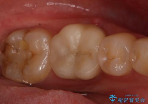 左下奥歯が腫れて痛い　フルジルコニアクラウンの症例 治療前