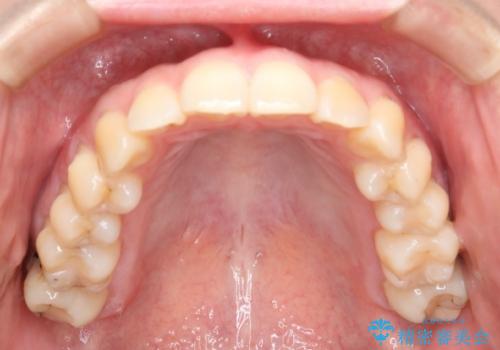 下の前歯のガタつきを治したい インビザライン・ライトパッケージの治療前