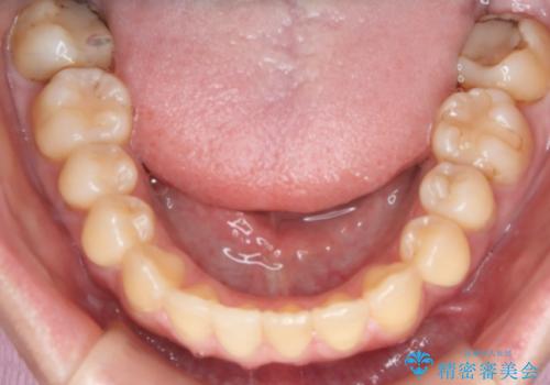 下の前歯のガタつきを治したい インビザライン・ライトパッケージの治療後
