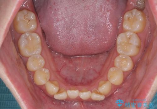 前歯のねじれ 矯正治療による歯並び改善の治療前